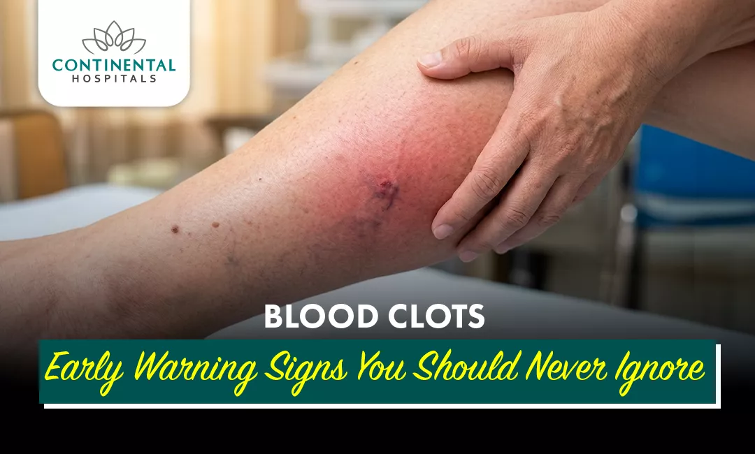 Blood Clots: Early Warning Signs You Should Never Ignore