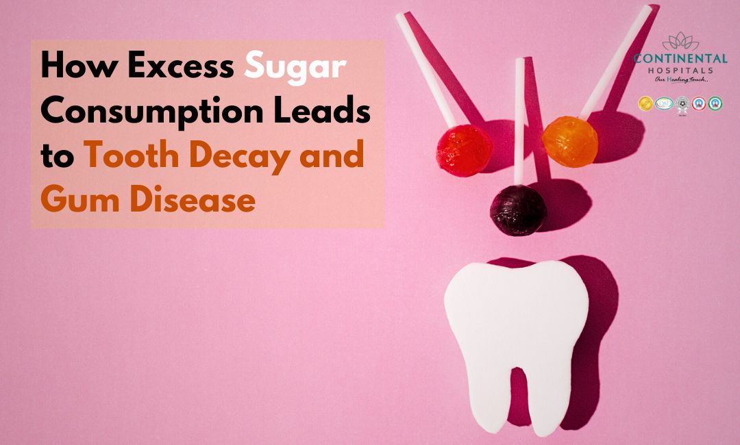 How Excess Sugar Consumption Leads to Tooth Decay and Gum Disease