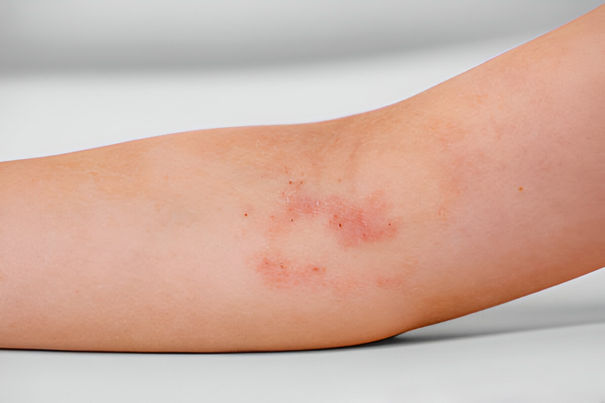 Pediatric Allergy
