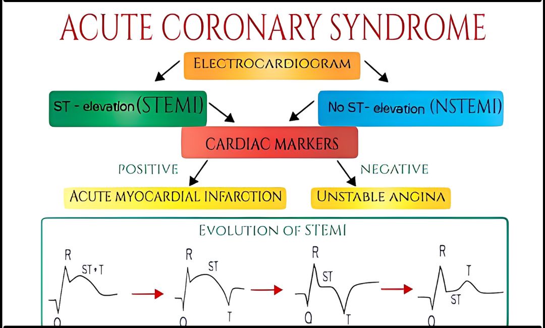 Acute Coronary Syndrome: Causes, Risk Factors, Symptoms, Treatment