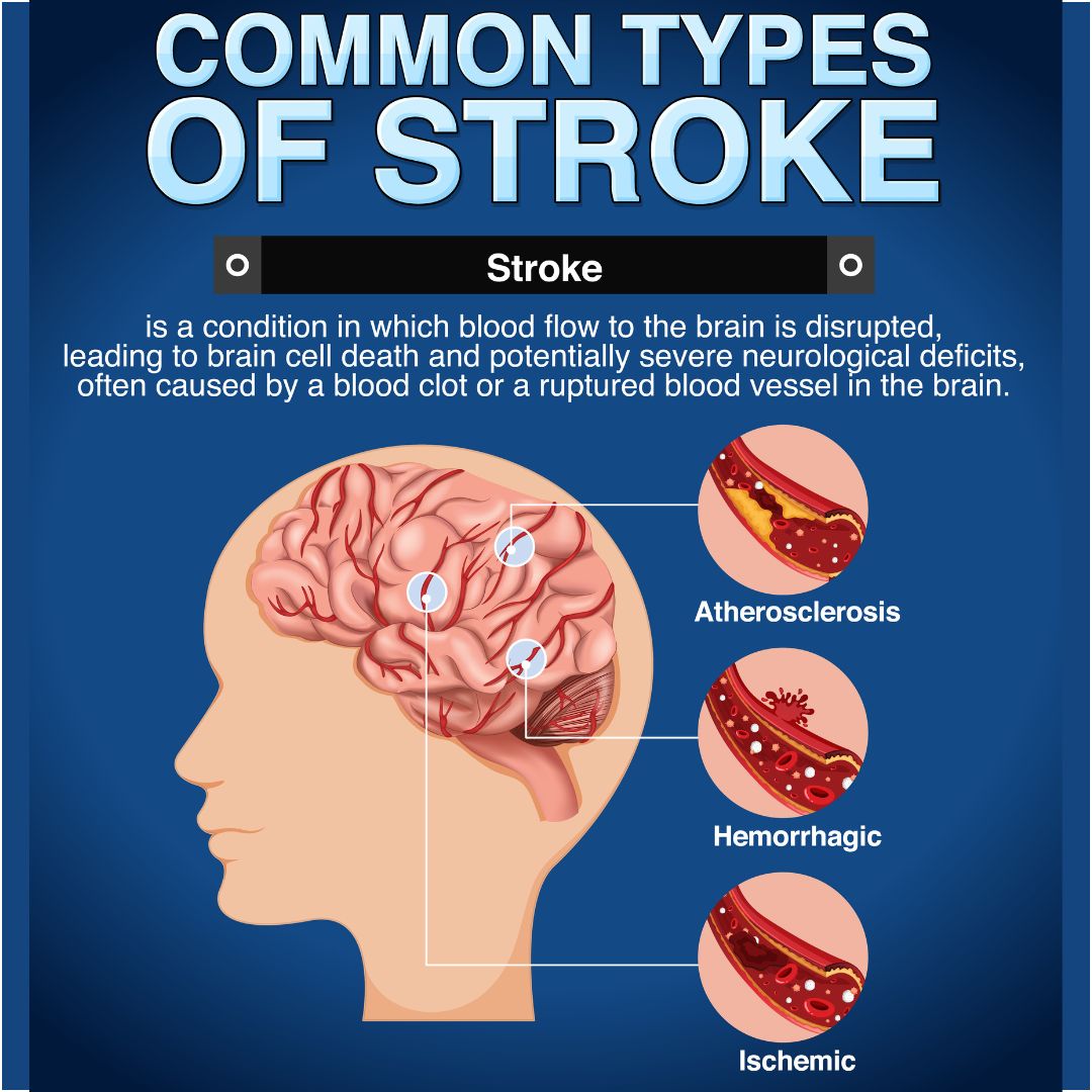 Stroke types