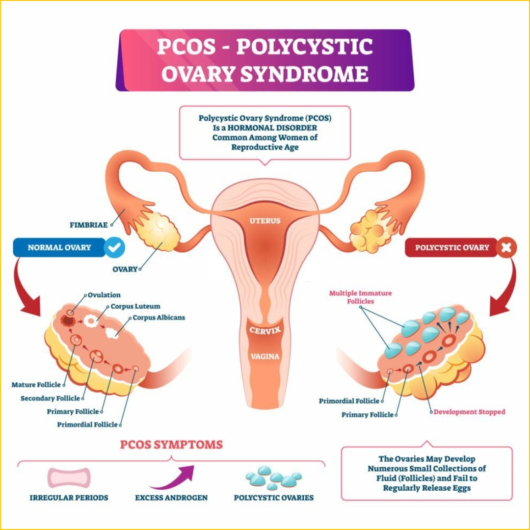 Polycystic Ovary Syndrome -PCOS