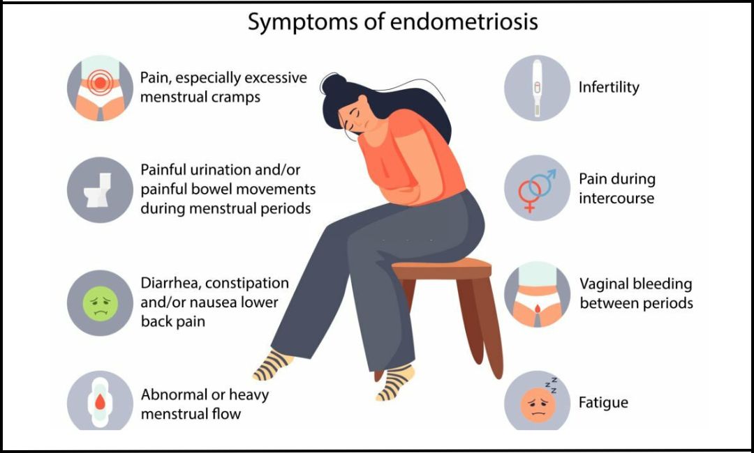 Medipal International Hospital - ⭕ Endometriosis Symptoms of endometriosis  include; Painful periods · Pain during or around ovulation · Pain during or  after sex · Heavy bleeding or irregular bleeding. Etc Consult