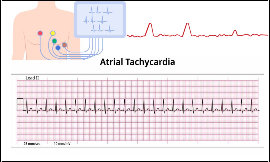 Atrial tachycardia: Causes, Risk Factors, Symptoms, Treatment