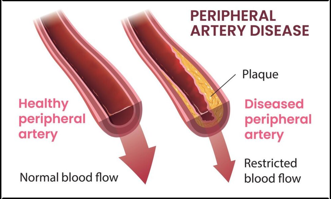 Peripheral Artery Disease 