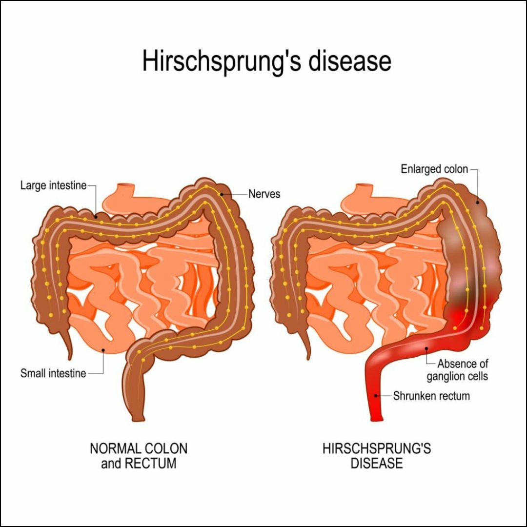 Hirschsprung Disease