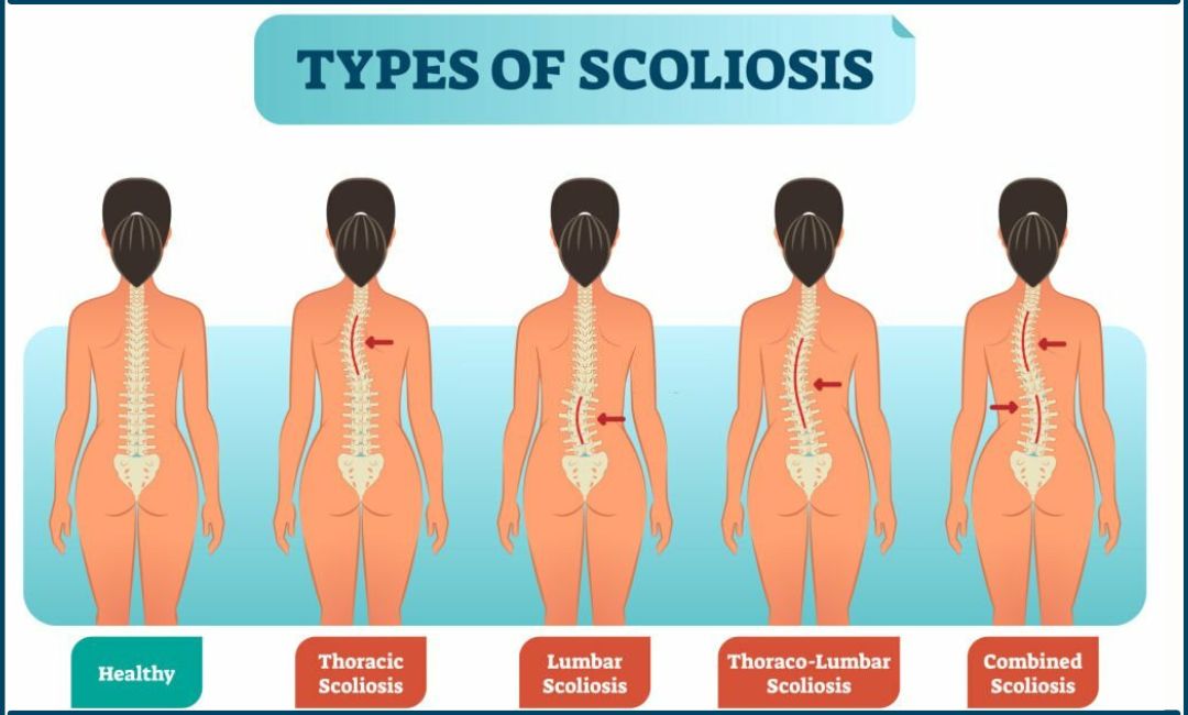 Scoliosis 