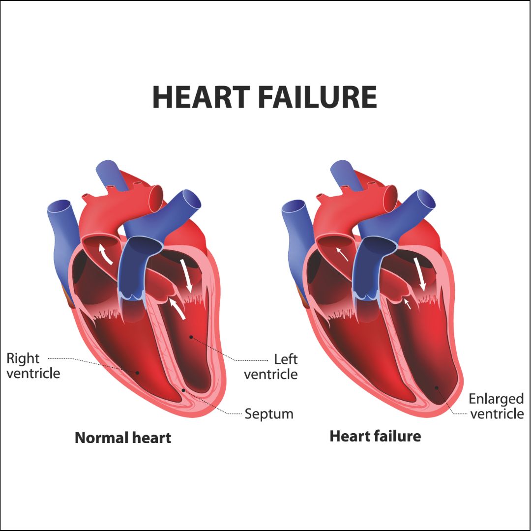 Heart Failure Causes Risk Factors Symptoms Treatment
