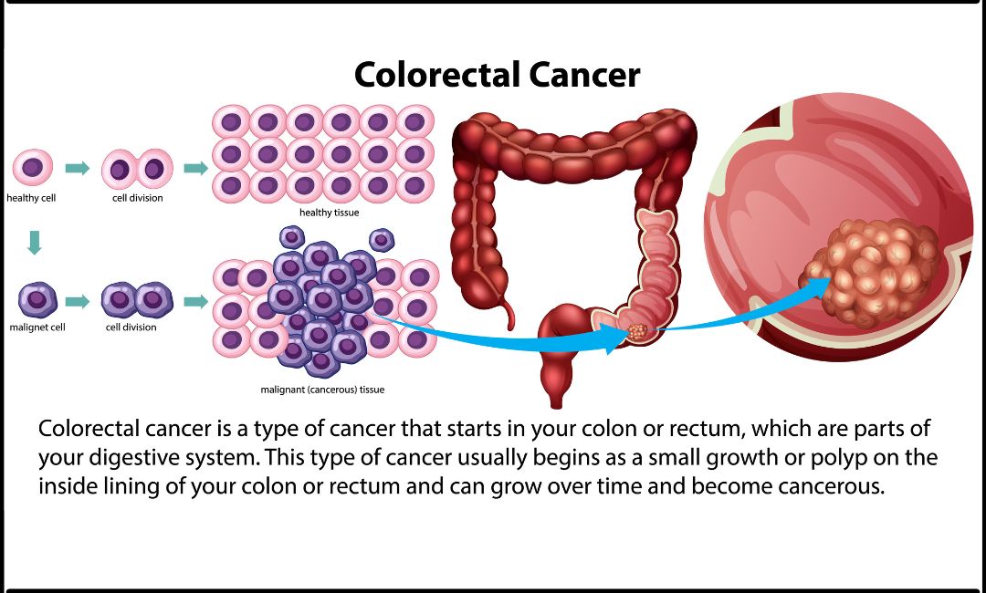 Colorectal cancer