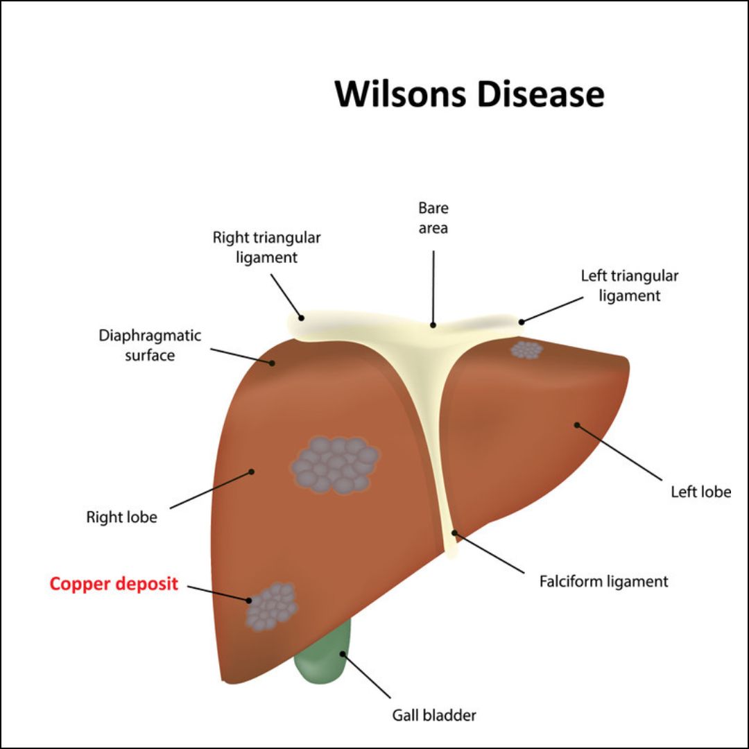 Wilsons Disease