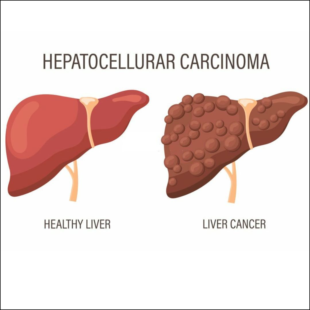 Hepatocellular Cancer: Causes, Risk Factors, Symptoms, Treatment