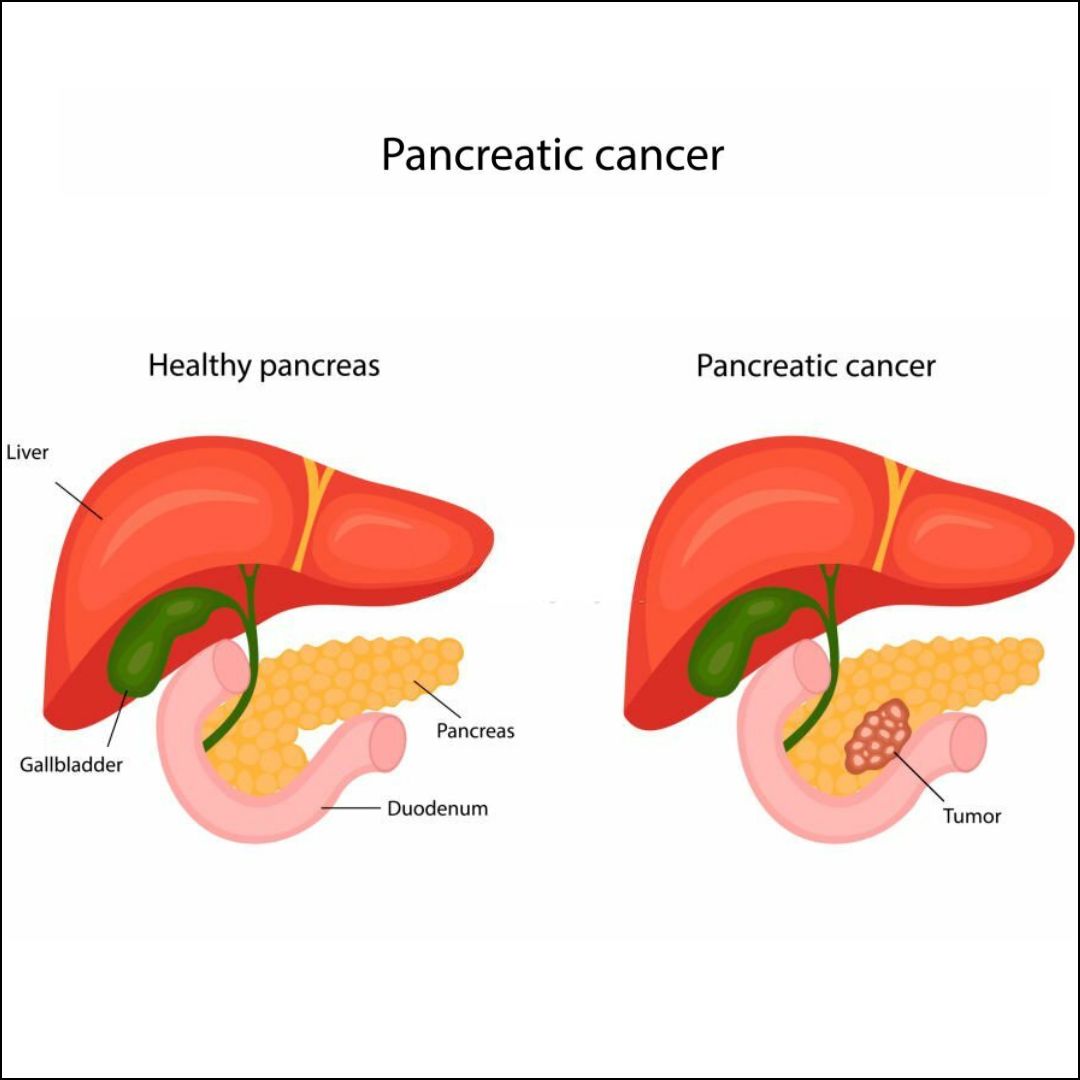 Pancreatic Cnacer
