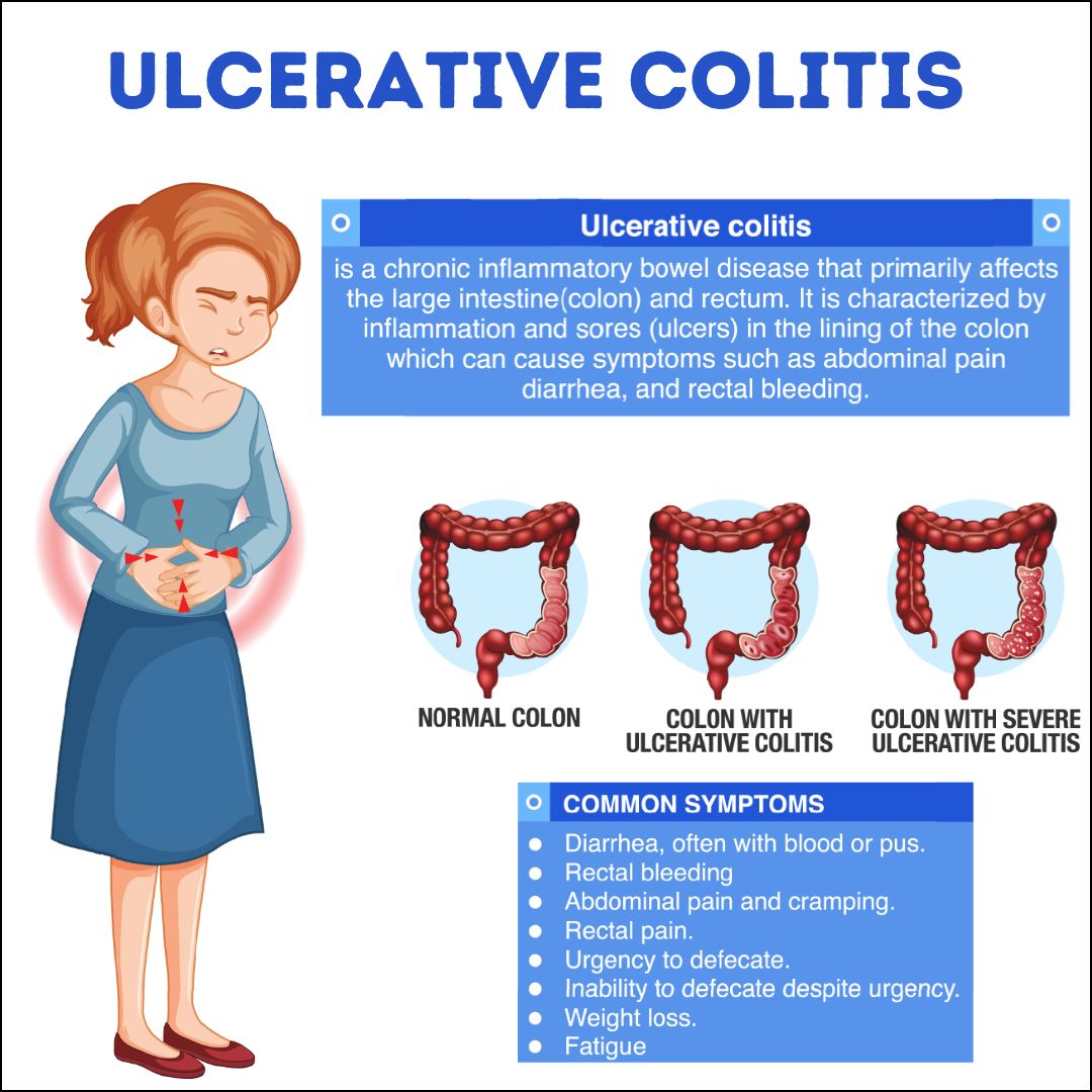Ulcerative Colitis 