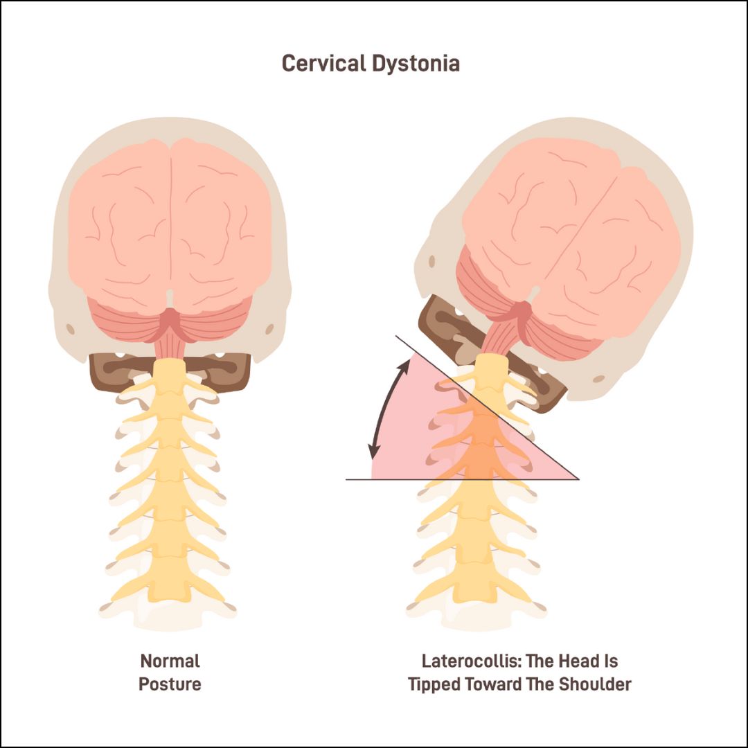 Cervical dystonia