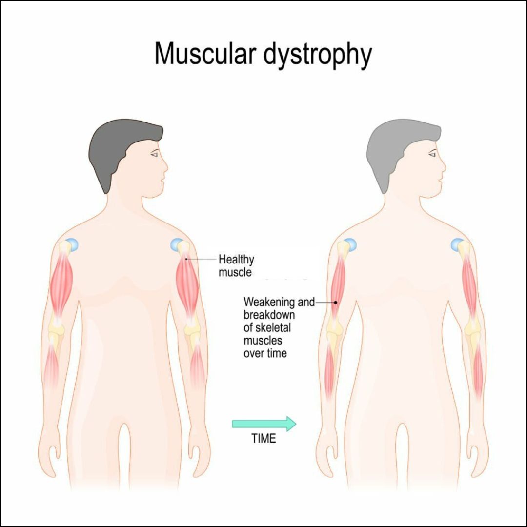 Symptoms of Muscular dystrophy