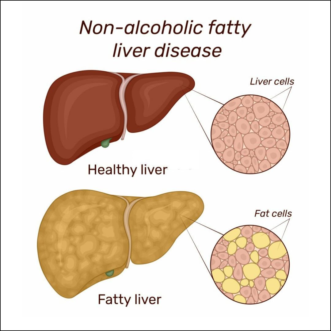 Fatty Liver Disease Symptoms In Kids Infoupdate Fatty Liver Disease Symptoms In Kids Infoupdate