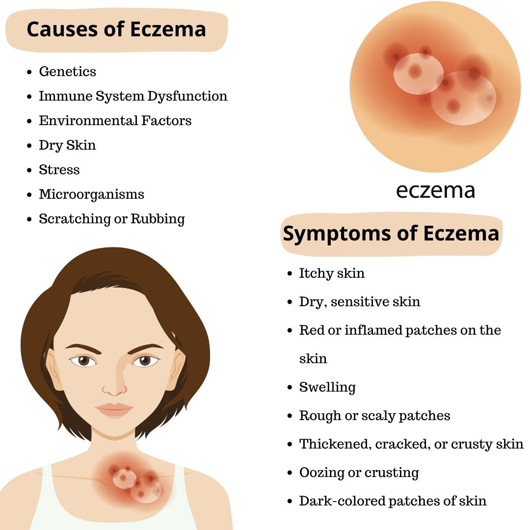 Causes and Symptoms of Eczema