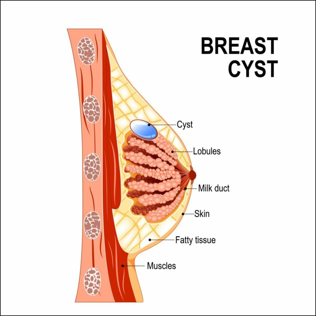 Breast Cyst