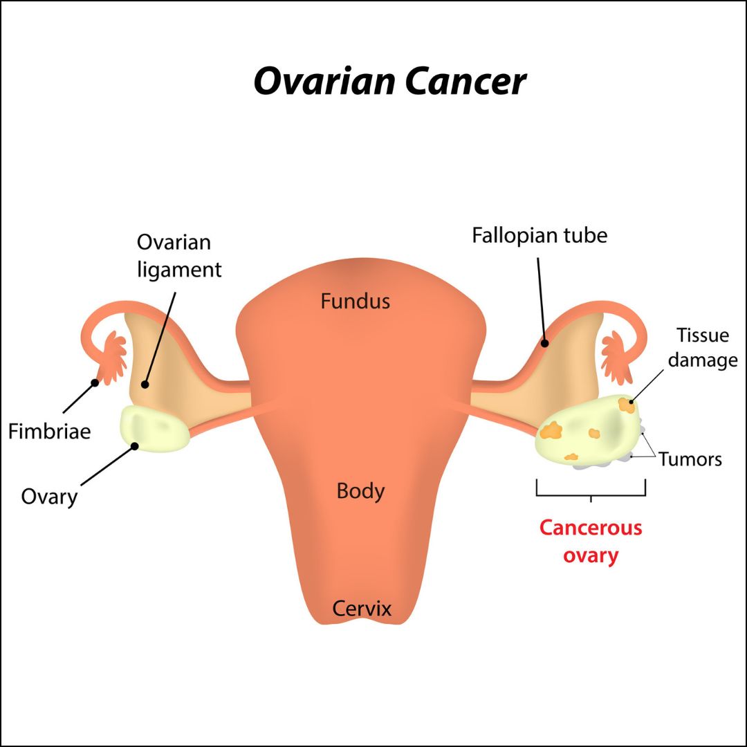 Ovarian Cnacer