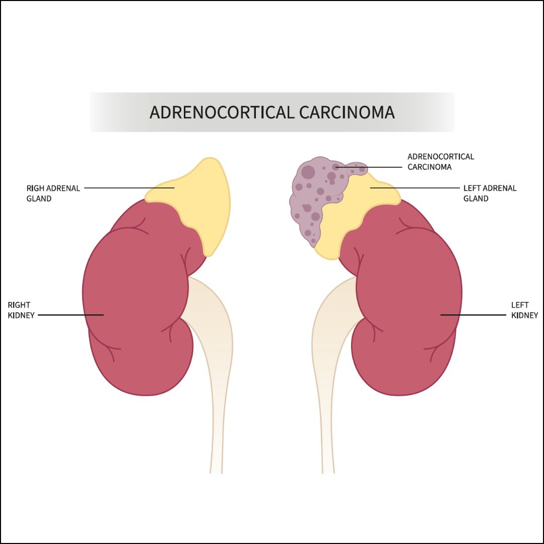 Adrenocortical carcinoma