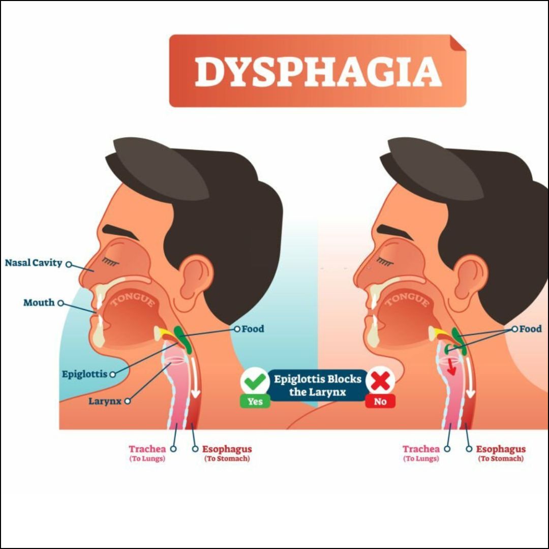 Dysphagia 