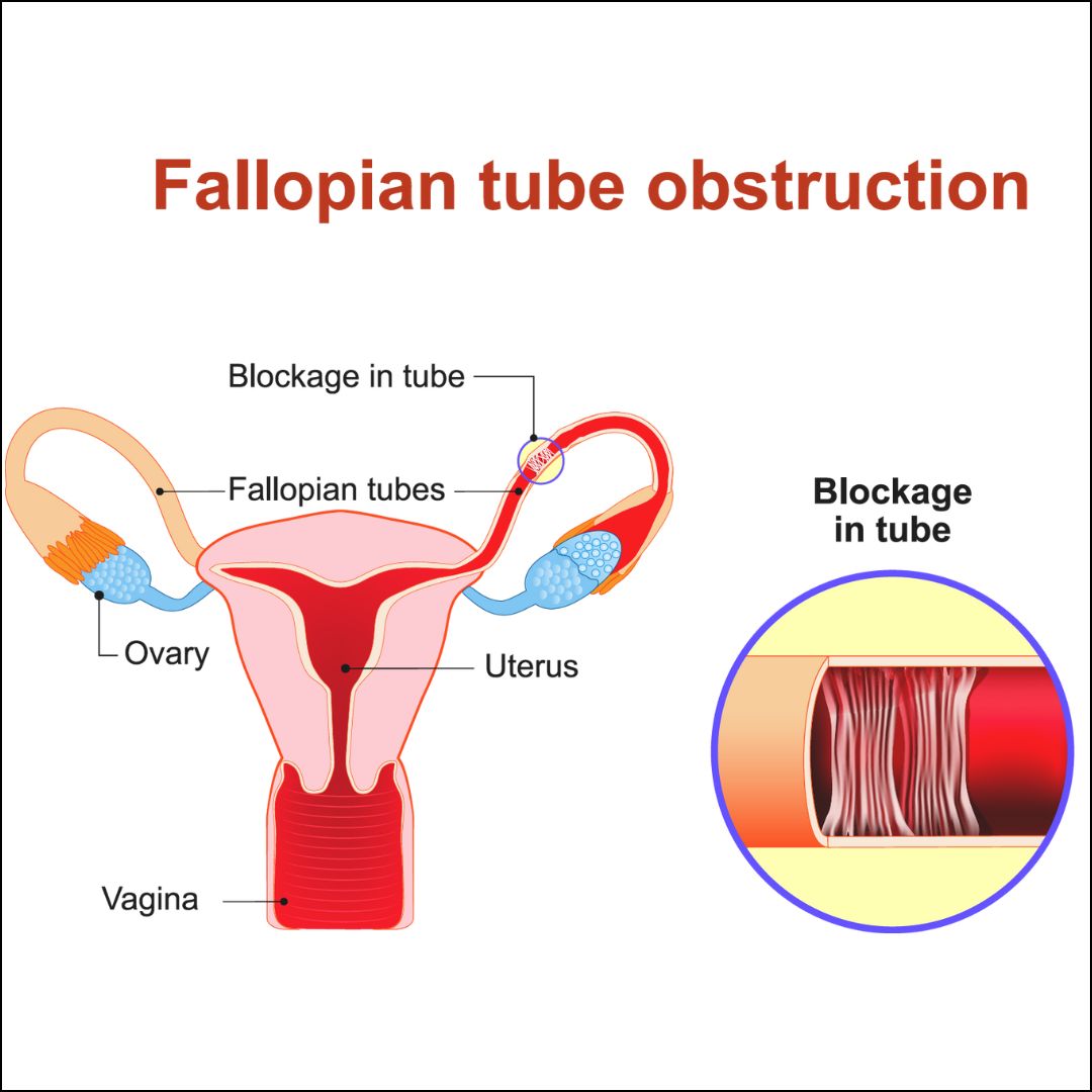 Fallopian tube cancer