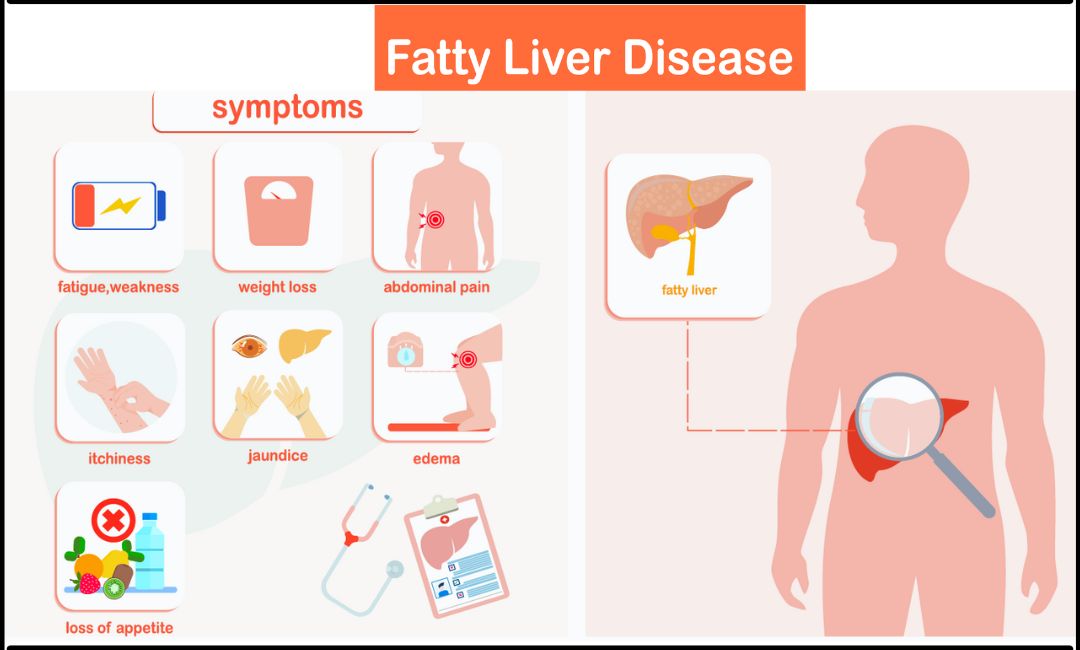 Symptoms of Fatty Liver Disease
