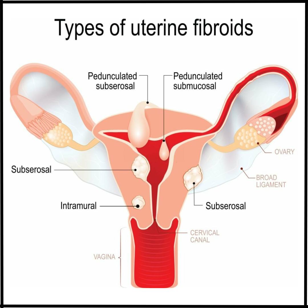 Uterine fibroids