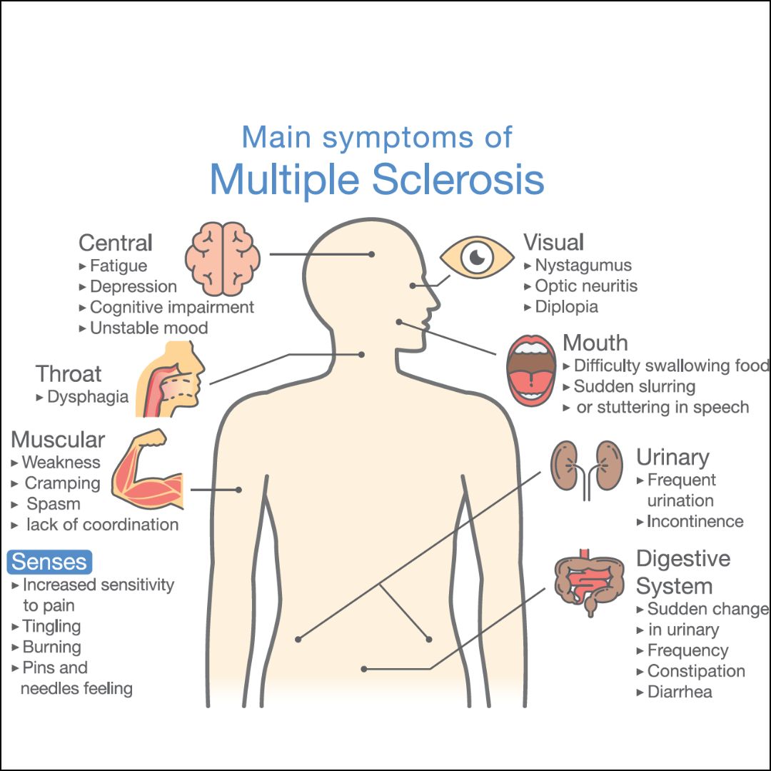 Multiple sclerosis: Causes, Risk Factors, Symptoms, Treatment