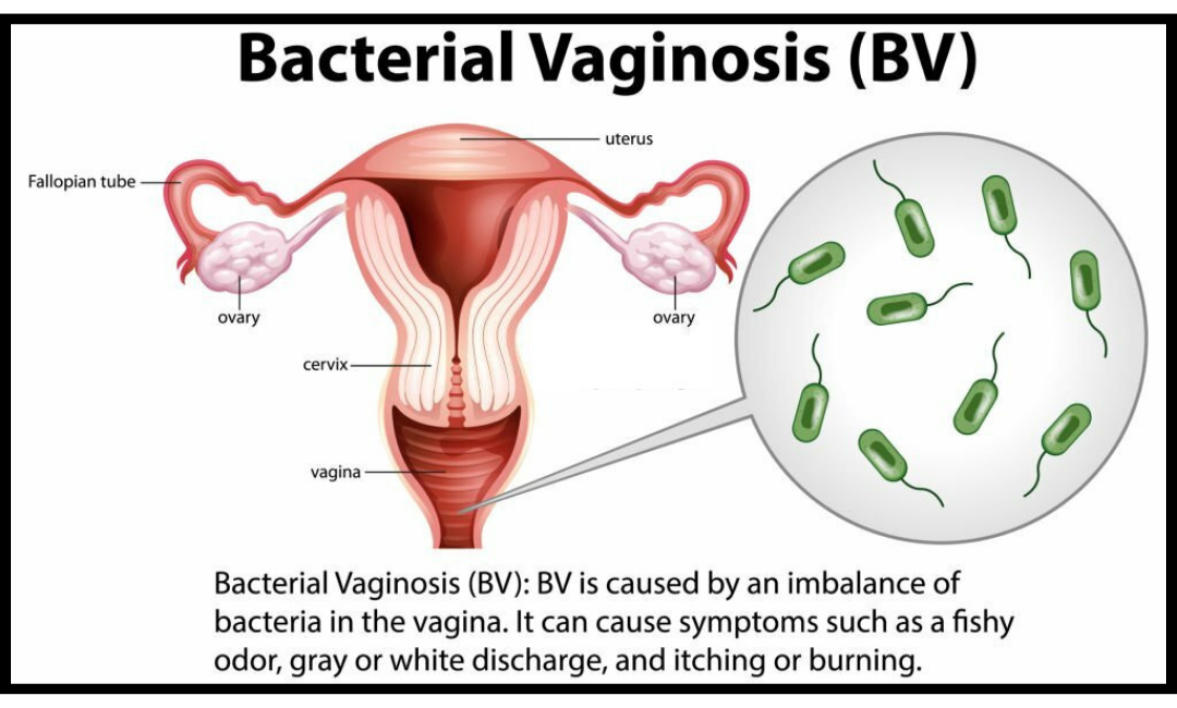 Bacterial vaginosis: Causes, Risk Factors, Symptoms, Treatment