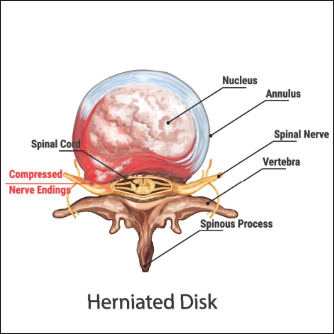 herniated disk