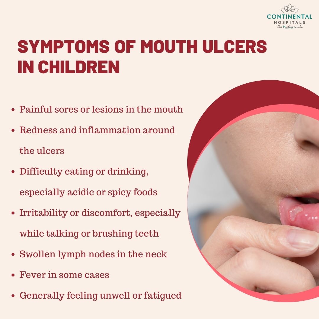 Symptoms of Mouth Ulcers in Children
