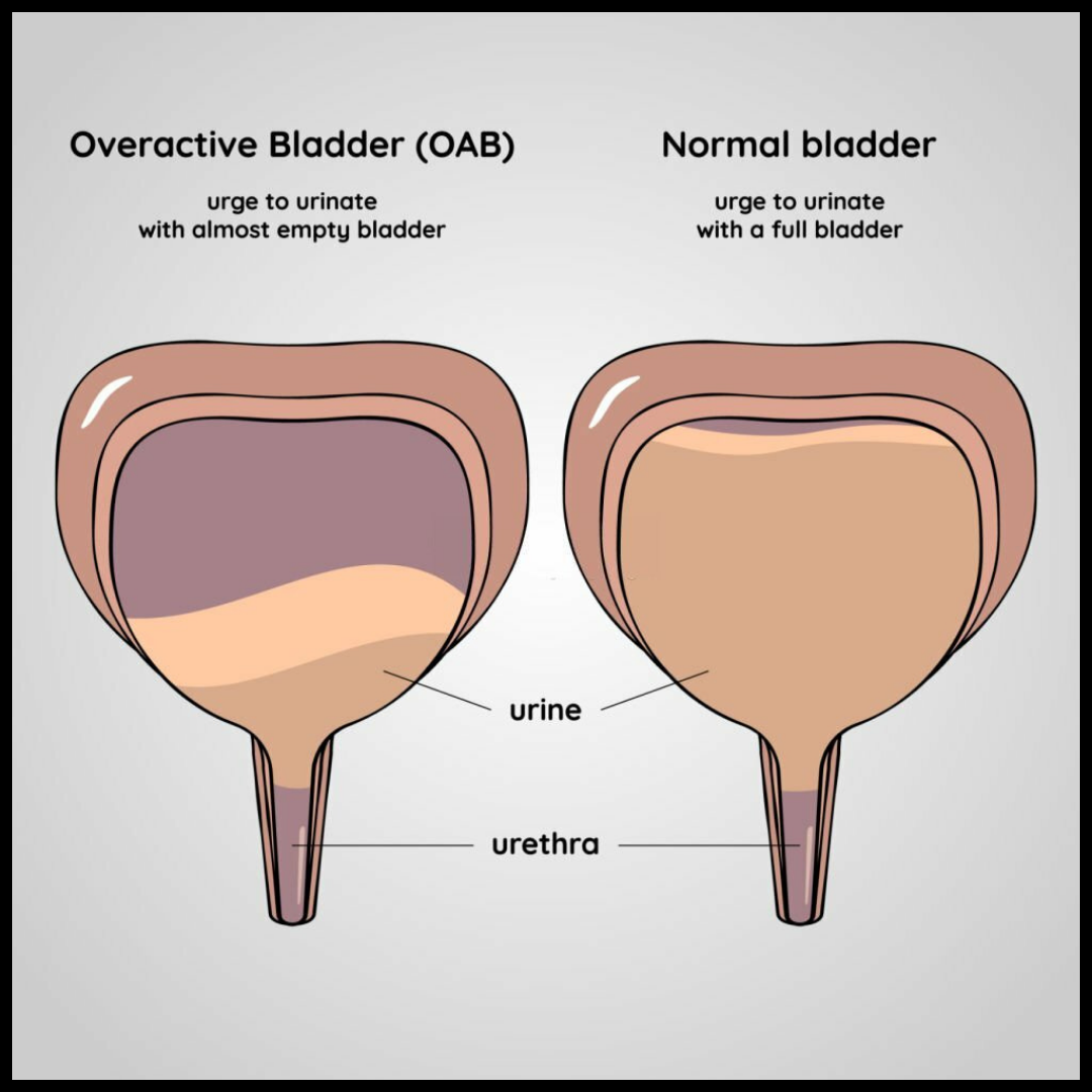 Overactive bladder