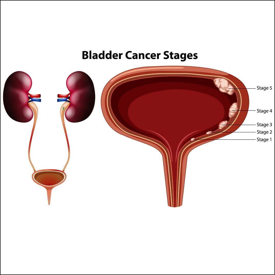 Bladder Cancer Stages