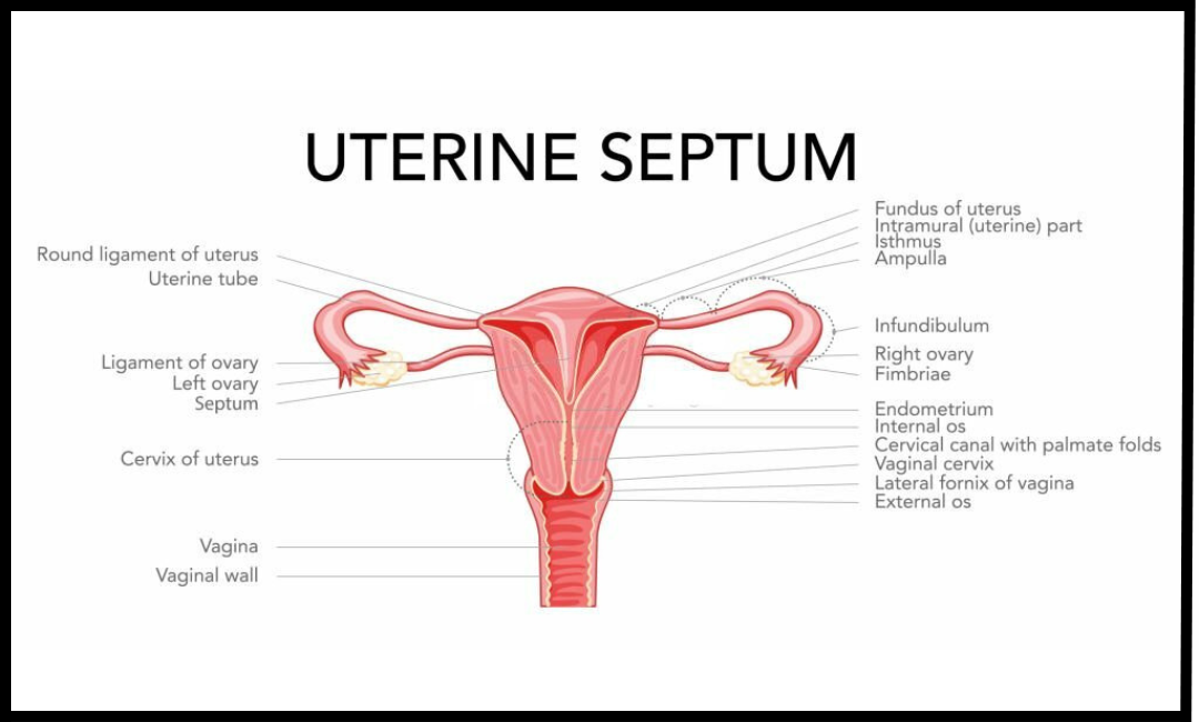 Septate uterus