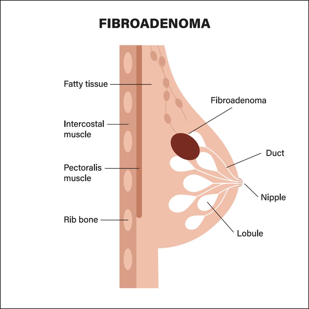 Fibroadenomas 