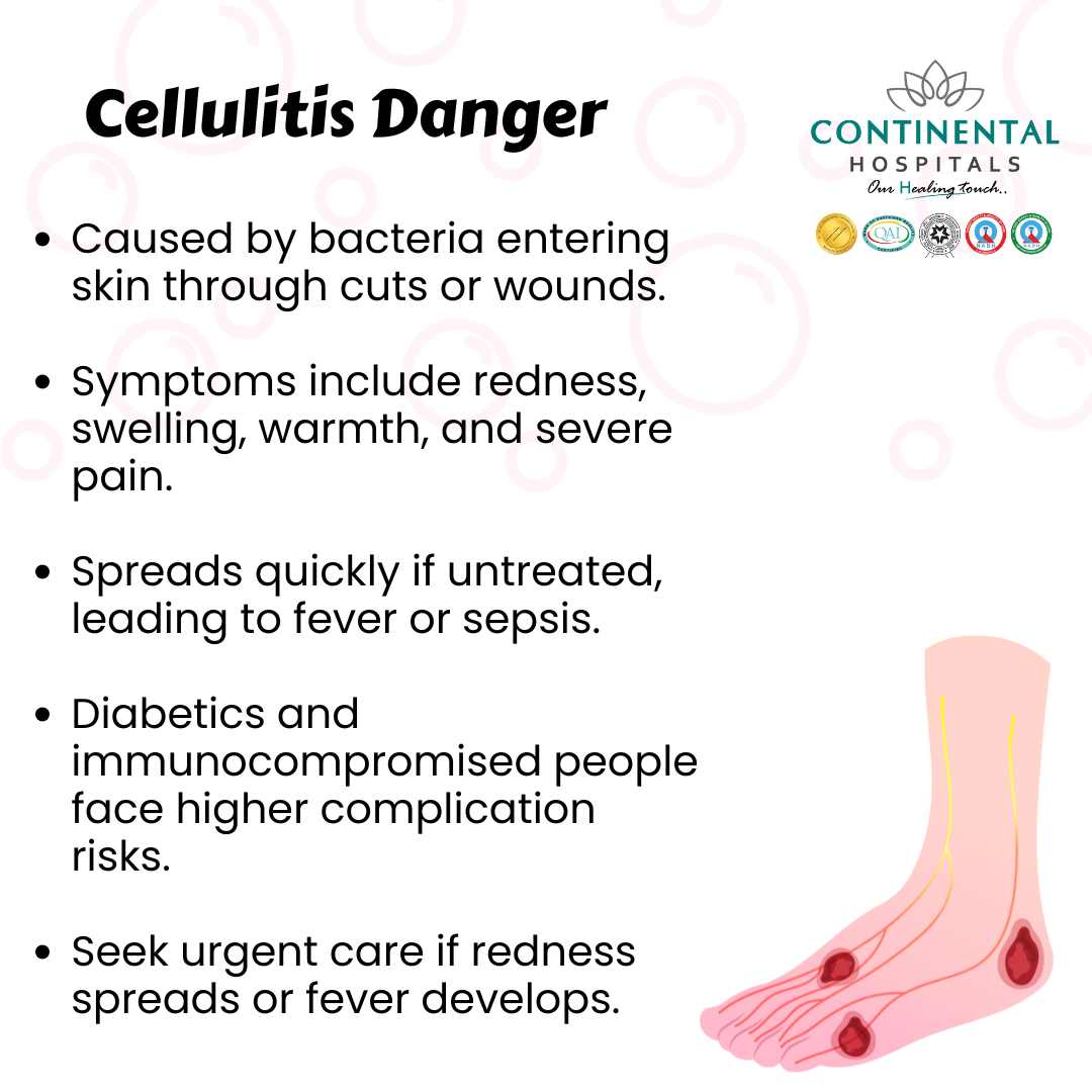 Cellulitis Foot Treatment