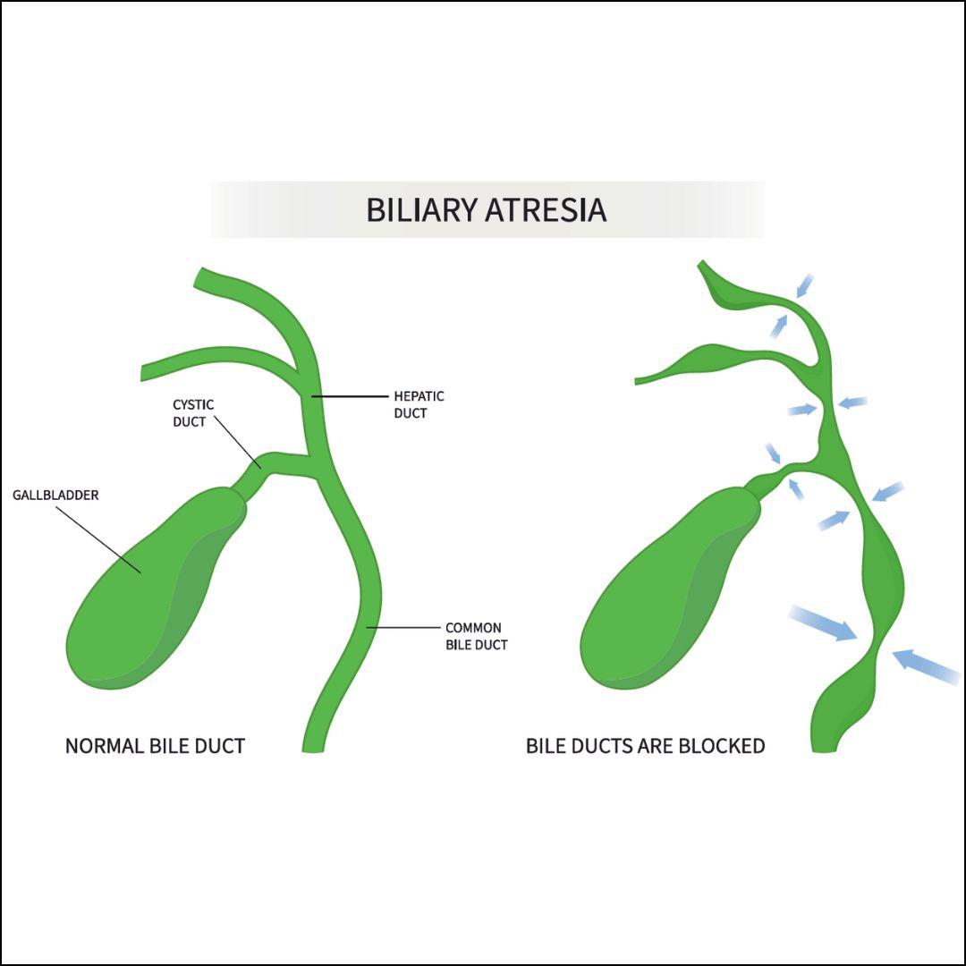 Biliary Artesia