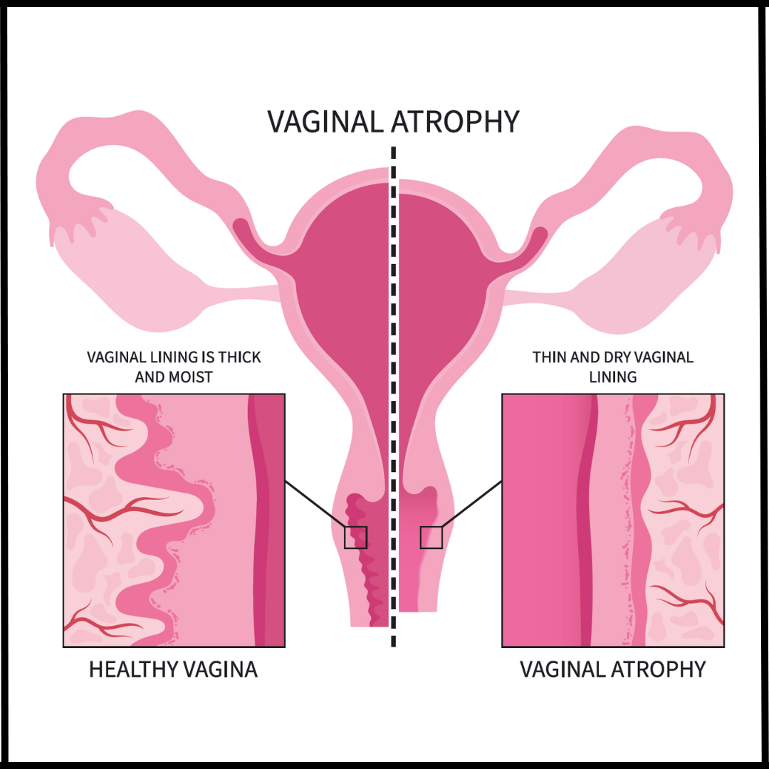 Vaginal atrophy