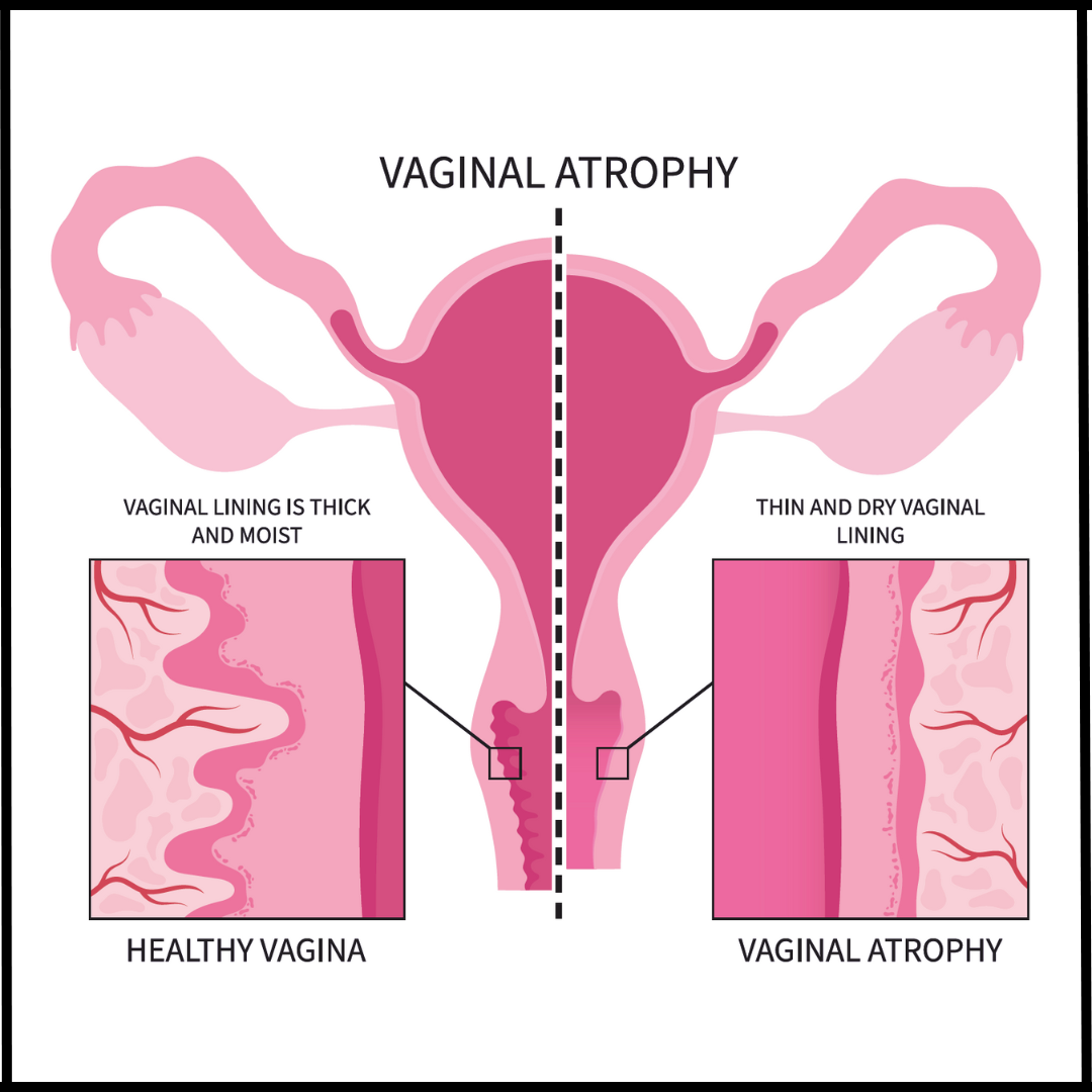 Vaginal Atrophy Causes Risk Factors Symptoms Treatment