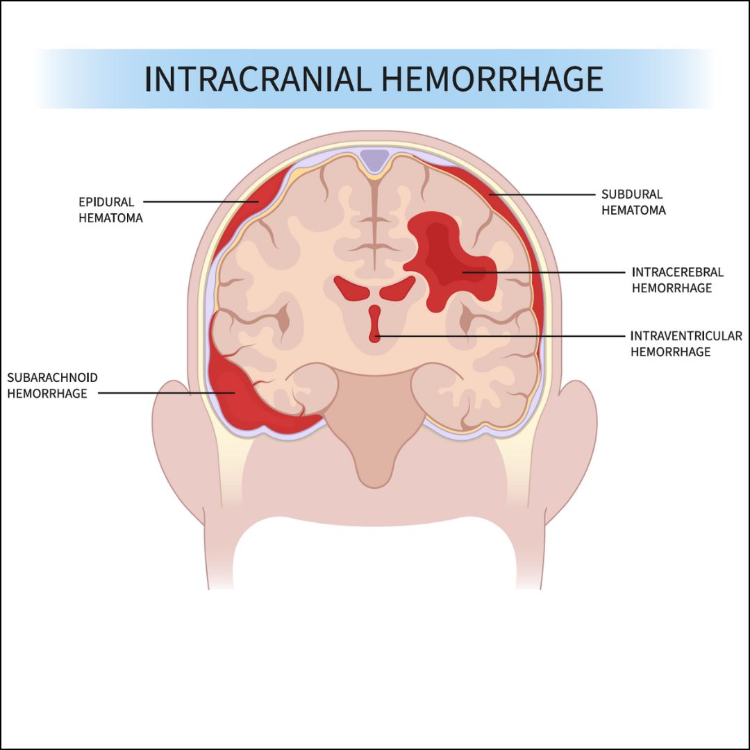 Intracranial hemorrhage