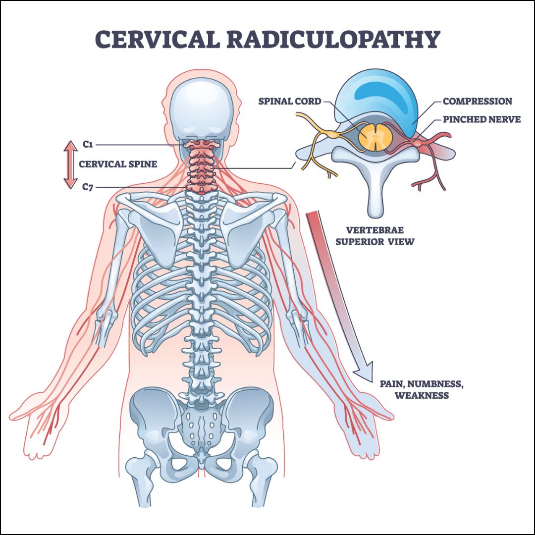 Cervical radiculopathy
