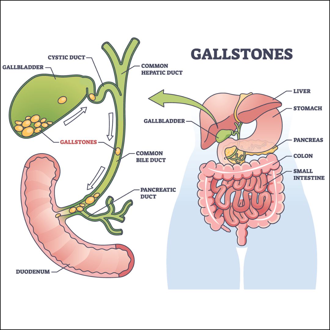 Gall bladder stones