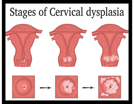 Cervical dysplasia