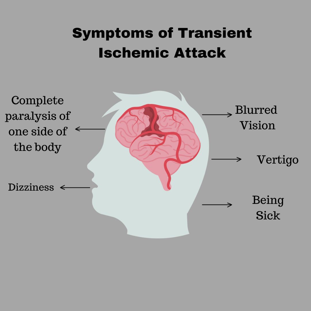 Symptoms of Transient Ischemic Attack