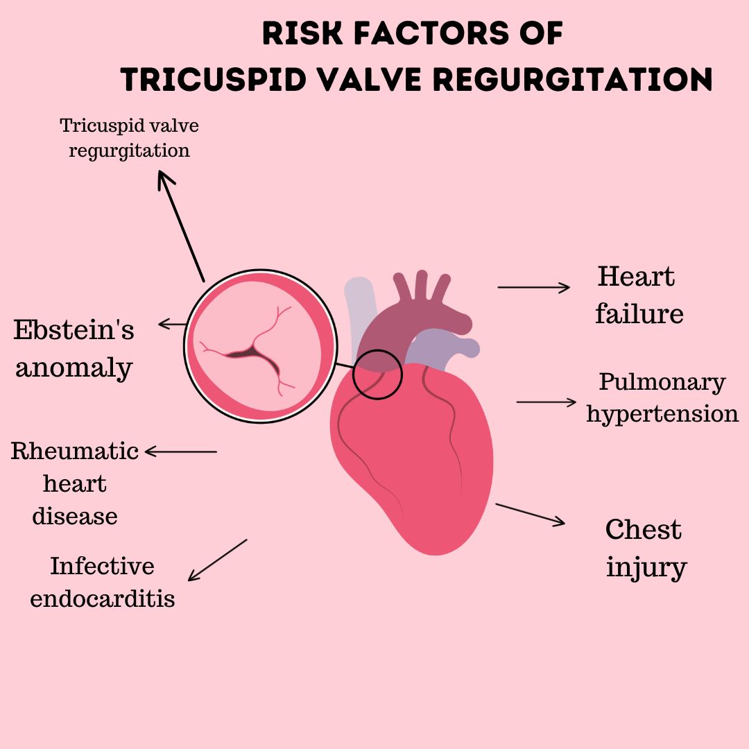 Risk Factors of Tricuspid valve regurgitation
